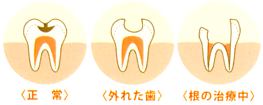 歯の状態を比較